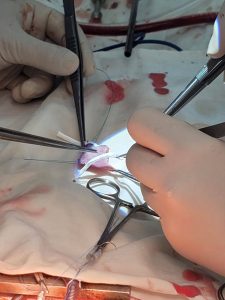 Oʻzbekistonda ilk bor unikal yurak jarrohligi amalga oshirildi